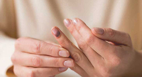 Trajtimi dhe shërimi i gishtit të thyer