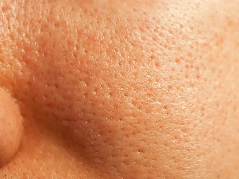 Çfarë e shkakton “lëkurën e portokallit” në fytyrë?