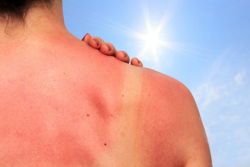 10 mënyra për të lehtësuar menjëherë dhimbjen e djegies nga dielli